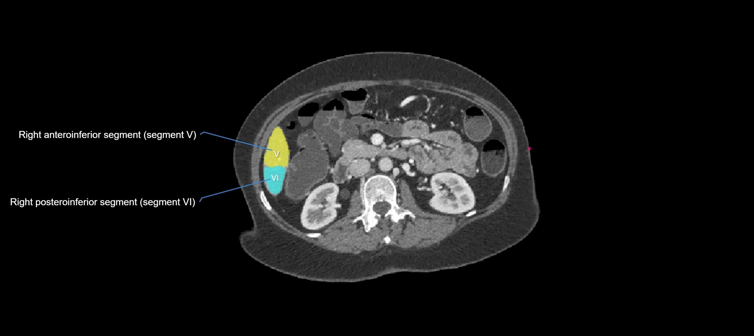 CT liver segments axial cross sectional anatomy labelled image-00014.webp